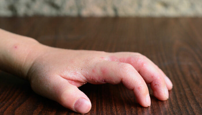 8 first-line treatment options for atopic dermatitis in infants